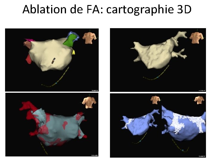 Ablation de FA: cartographie 3 D 