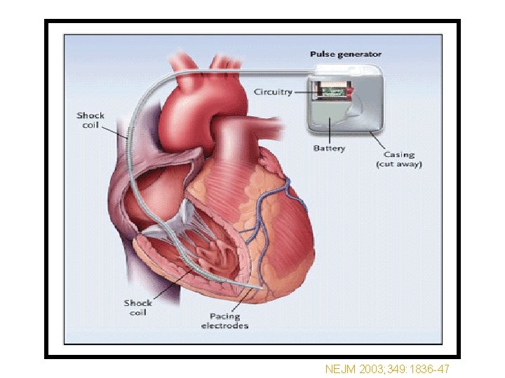 NEJM 2003; 349: 1836 -47 