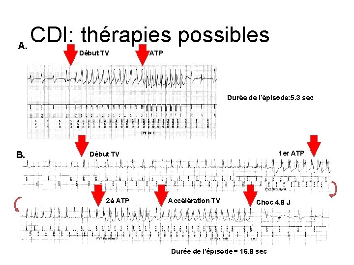 A. CDI: thérapies possibles Début TV ATP Durée de l’épisode: 5. 3 sec B.