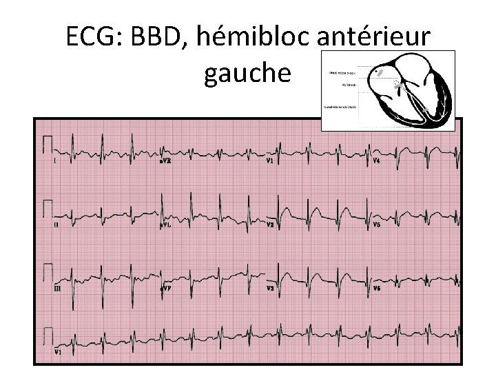 ECG: BBD, hémibloc antérieur gauche 