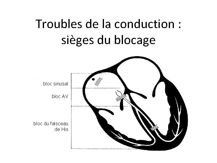 Troubles de la conduction : sièges du blocage bloc sinusal bloc AV bloc du