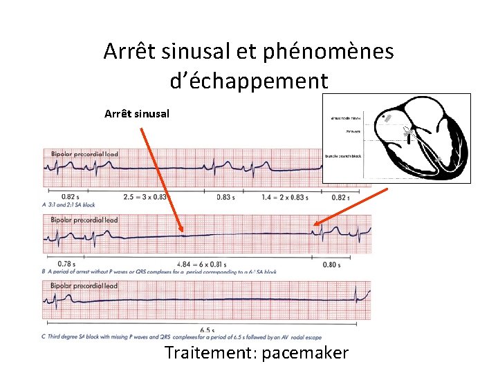 Arrêt sinusal et phénomènes d’échappement Arrêt sinusal Échappement Traitement: pacemaker 