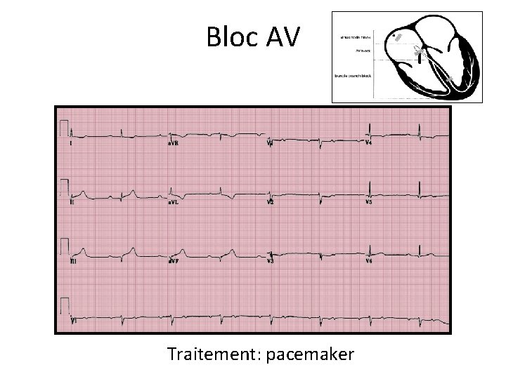 Bloc AV Traitement: pacemaker 