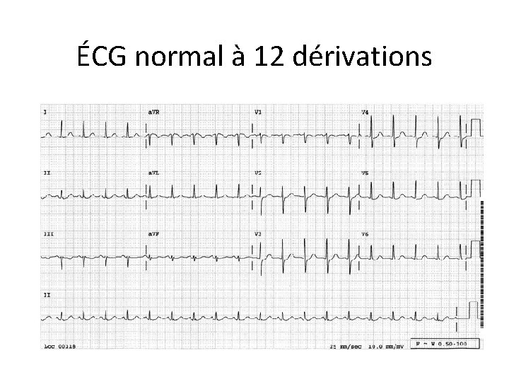 ÉCG normal à 12 dérivations 