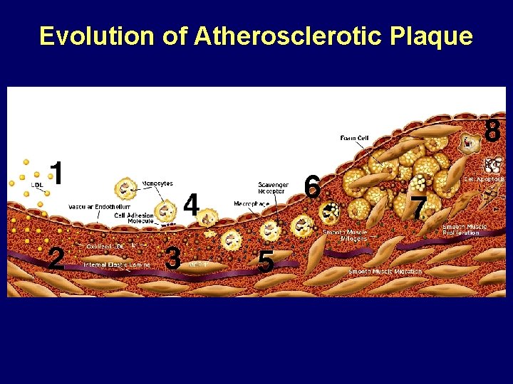 Evolution of Atherosclerotic Plaque Libby P. The Vascular Biology of Atherosclerosis. In: Braunwald, Zipes,