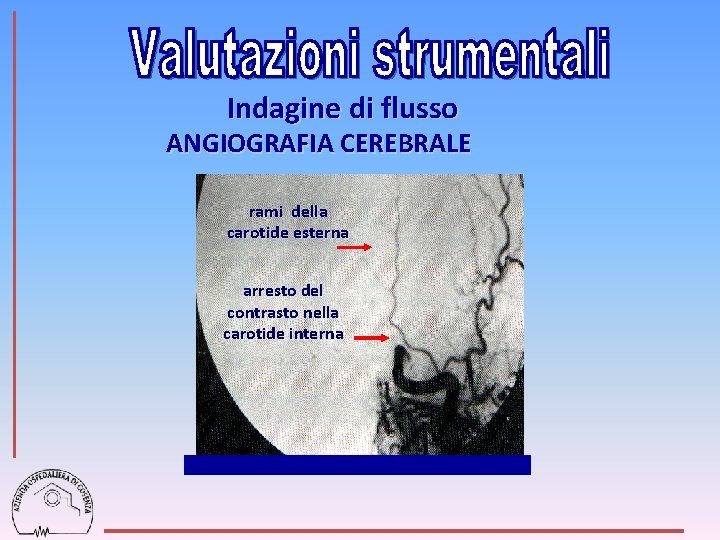 Indagine di flusso ANGIOGRAFIA CEREBRALE rami della carotide esterna arresto del contrasto nella carotide