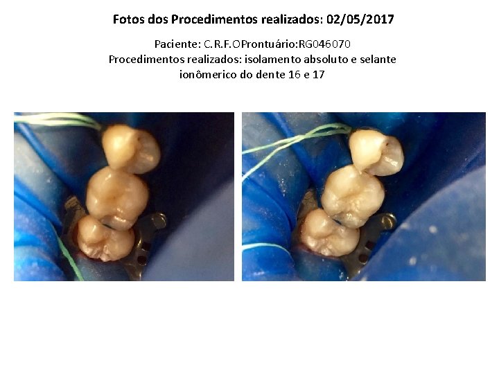 Fotos dos Procedimentos realizados: 02/05/2017 Paciente: C. R. F. OProntuário: RG 046070 Procedimentos realizados: