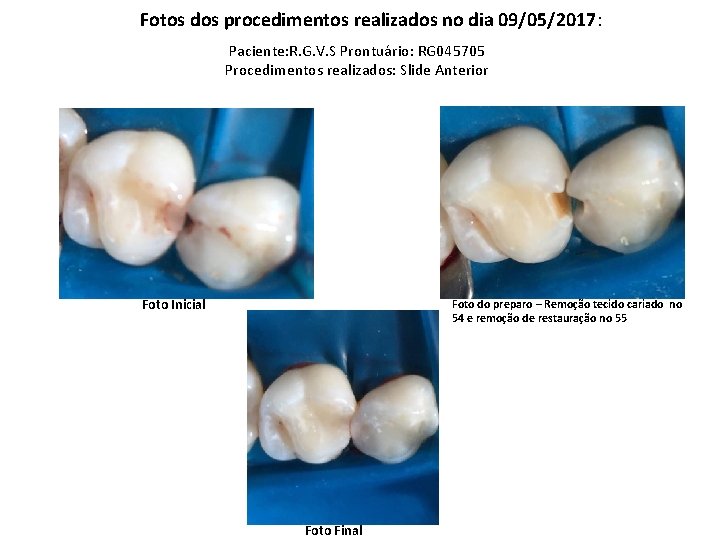 Fotos dos procedimentos realizados no dia 09/05/2017: Paciente: R. G. V. S Prontuário: RG