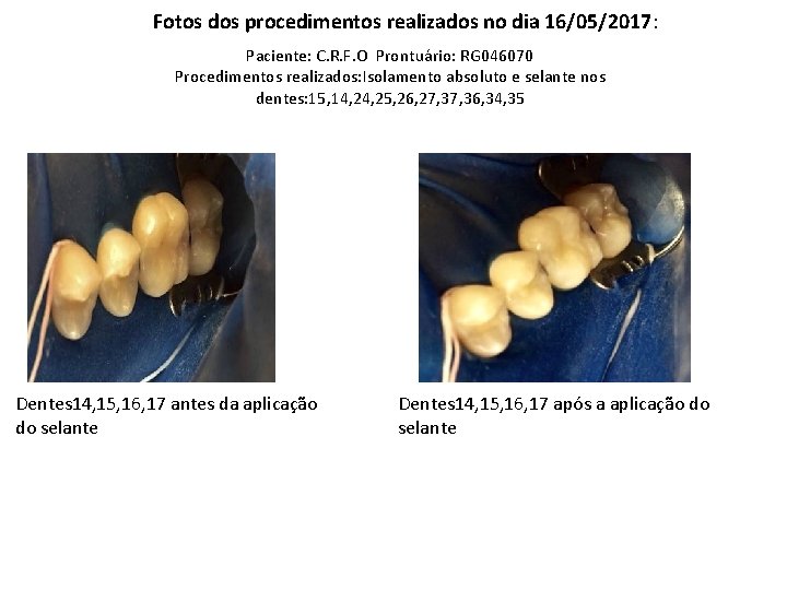 Fotos dos procedimentos realizados no dia 16/05/2017: Paciente: C. R. F. O Prontuário: RG