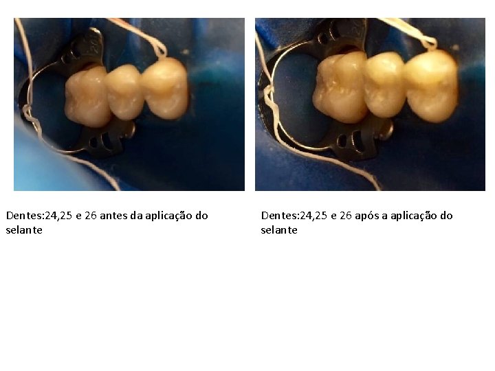 Dentes: 24, 25 e 26 antes da aplicação do selante Dentes: 24, 25 e