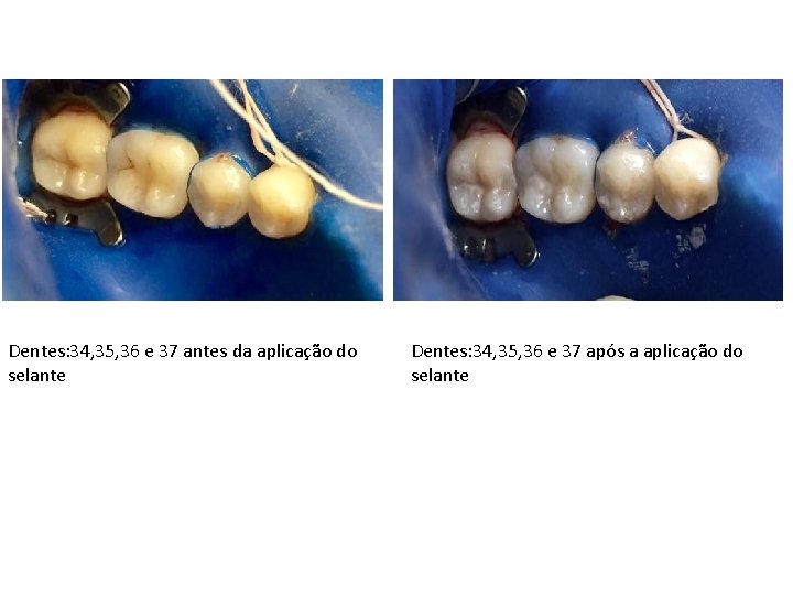 Dentes: 34, 35, 36 e 37 antes da aplicação do selante Dentes: 34, 35,