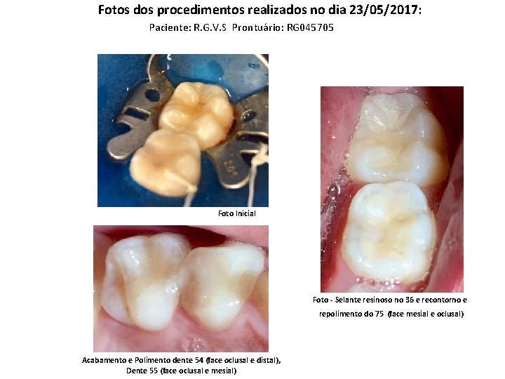 Fotos dos procedimentos realizados no dia 23/05/2017: Paciente: R. G. V. S Prontuário: RG