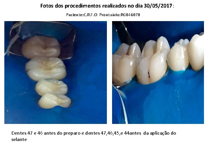 Fotos dos procedimentos realizados no dia 30/05/2017: Paciente: C. R. F. O Prontuário: RG