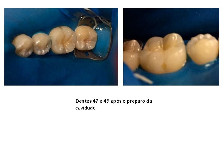 Dentes 47 e 46 após o preparo da cavidade 