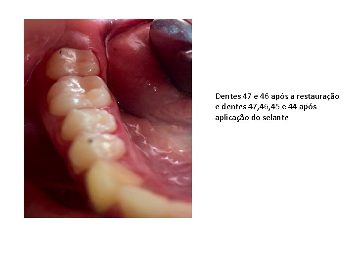 Dentes 47 e 46 após a restauração e dentes 47, 46, 45 e 44