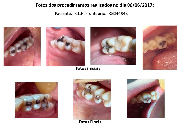 Fotos dos procedimentos realizados no dia 06/06/2017: Paciente: R. L. F Prontuário: RG 044943