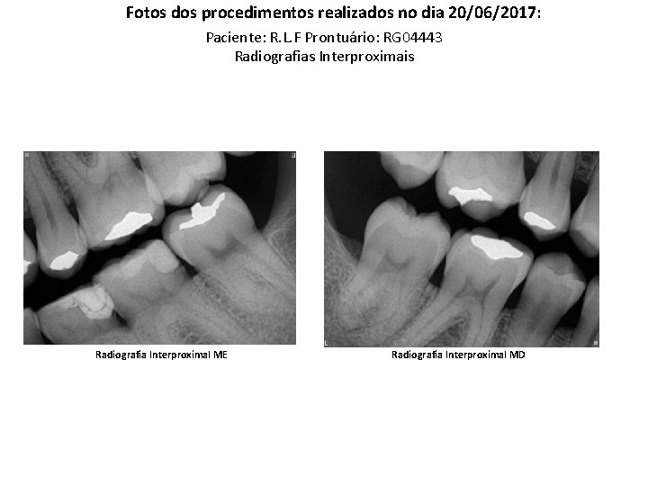 Fotos dos procedimentos realizados no dia 20/06/2017: Paciente: R. L. F Prontuário: RG 04443