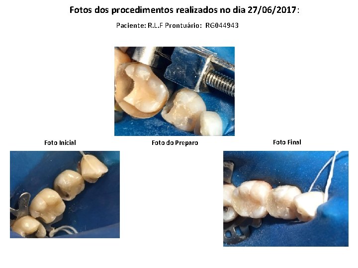 Fotos dos procedimentos realizados no dia 27/06/2017: Paciente: R. L. F Prontuário: RG 044943