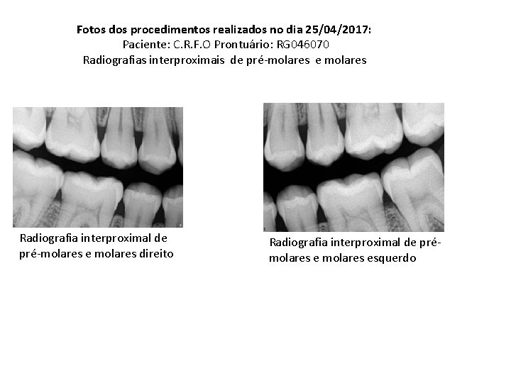 Fotos dos procedimentos realizados no dia 25/04/2017: Paciente: C. R. F. O Prontuário: RG