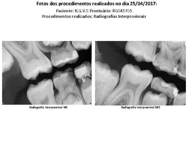 Fotos dos procedimentos realizados no dia 25/04/2017: Paciente: R. G. V. S Prontuário: RG