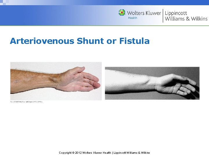 Arteriovenous Shunt or Fistula Copyright © 2012 Wolters Kluwer Health | Lippincott Williams &