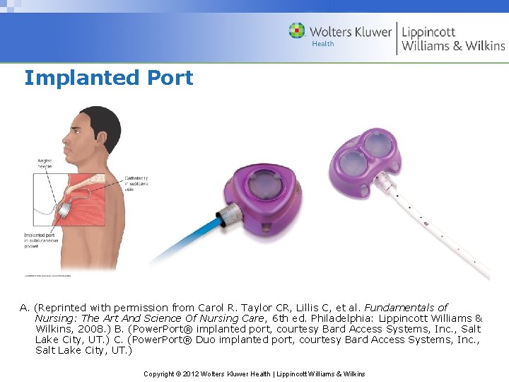 Implanted Port A. (Reprinted with permission from Carol R. Taylor CR, Lillis C, et