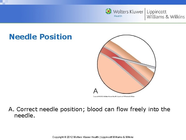 Needle Position A. Correct needle position; blood can flow freely into the needle. Copyright