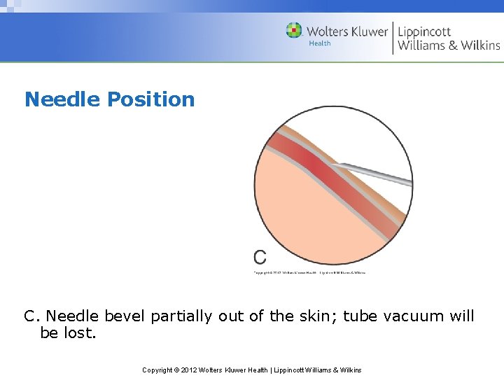 Needle Position C. Needle bevel partially out of the skin; tube vacuum will be
