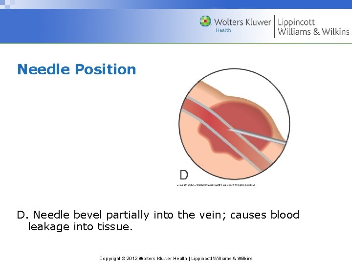 Needle Position D. Needle bevel partially into the vein; causes blood leakage into tissue.