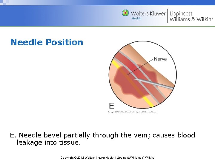 Needle Position E. Needle bevel partially through the vein; causes blood leakage into tissue.