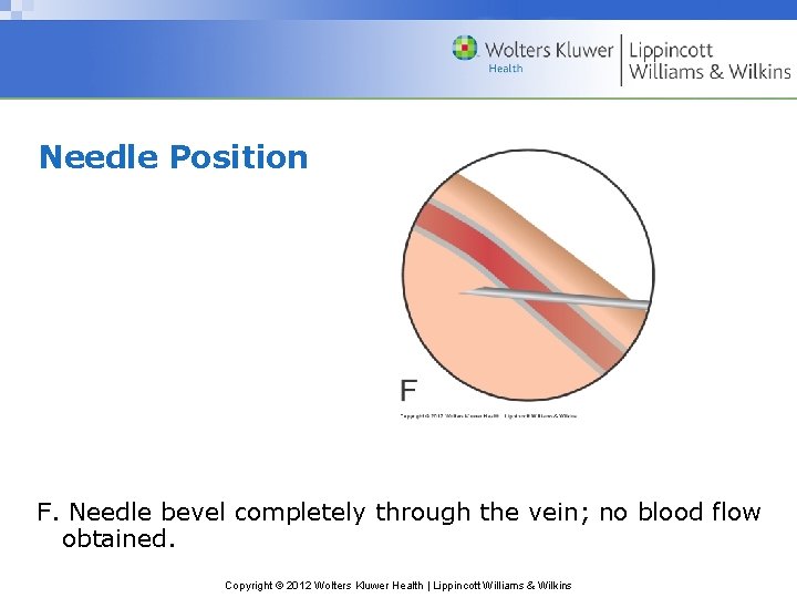 Needle Position F. Needle bevel completely through the vein; no blood flow obtained. Copyright