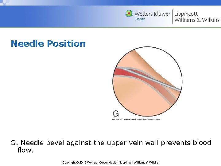 Needle Position G. Needle bevel against the upper vein wall prevents blood flow. Copyright