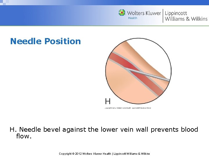 Needle Position H. Needle bevel against the lower vein wall prevents blood flow. Copyright