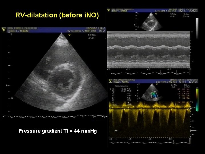 RV-dilatation (before i. NO) Pressure gradient TI = 44 mm. Hg RV-dilatation (before i. NO) Pressure gradient TI = 44 mm. Hg