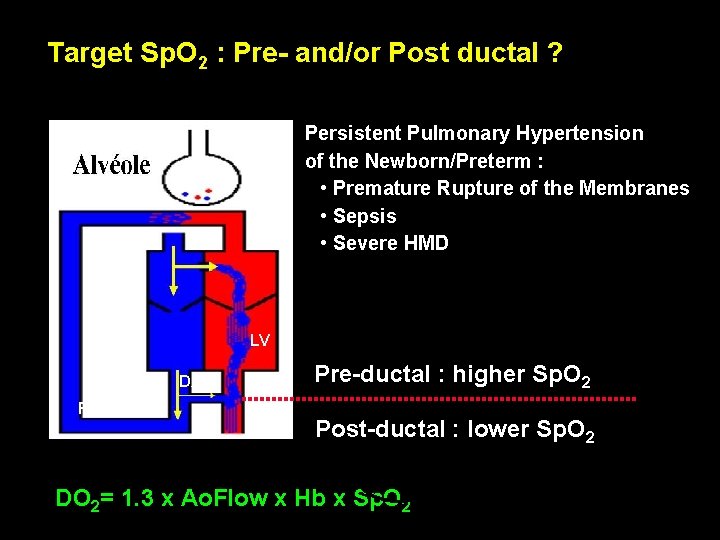 Target Sp. O 2 : Pre- and/or Post ductal ? Persistent Pulmonary Hypertension of Target Sp. O 2 : Pre- and/or Post ductal ? Persistent Pulmonary Hypertension of