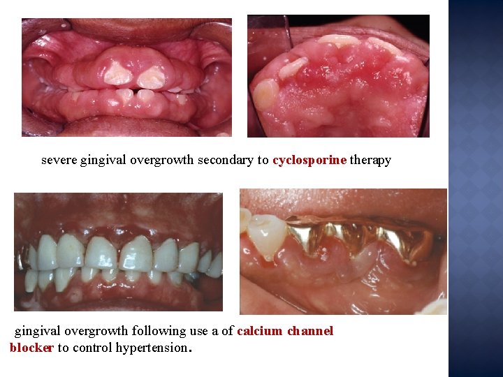 severe gingival overgrowth secondary to cyclosporine therapy gingival overgrowth following use a of calcium