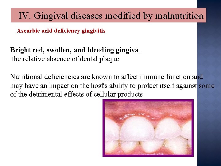 IV. Gingival diseases modified by malnutrition Ascorbic acid deficiency gingivitis Bright red, swollen, and