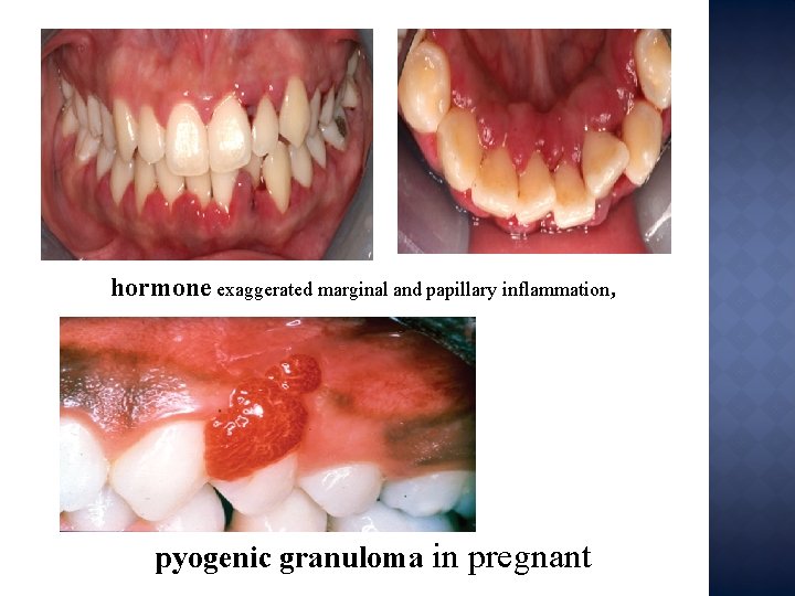 hormone exaggerated marginal and papillary inflammation, pyogenic granuloma in pregnant 