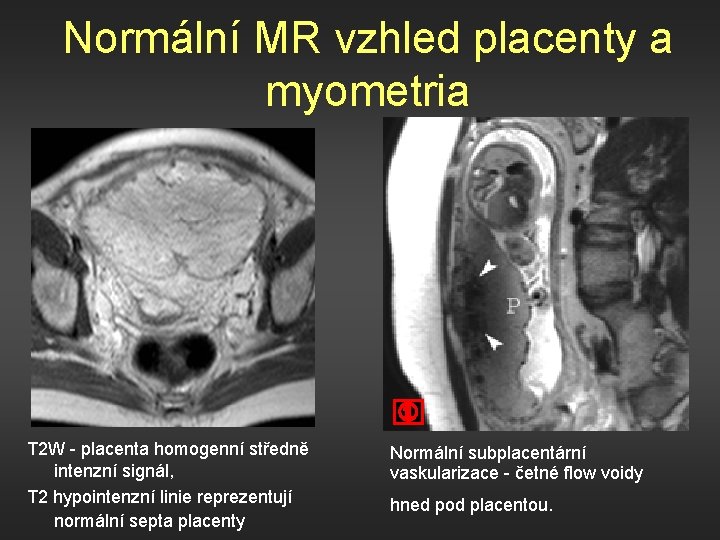 Normální MR vzhled placenty a myometria T 2 W - placenta homogenní středně intenzní