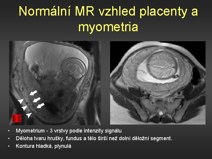 Normální MR vzhled placenty a myometria • • • Myometrium - 3 vrstvy podle