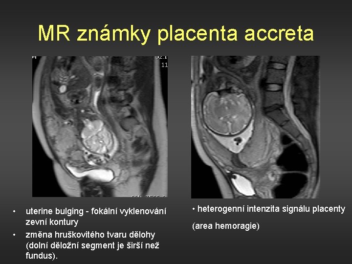 MR známky placenta accreta • • uterine bulging - fokální vyklenování zevní kontury změna