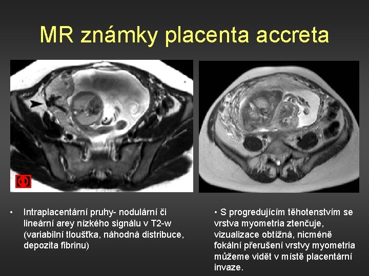 MR známky placenta accreta • Intraplacentární pruhy- nodulární či lineární arey nízkého signálu v