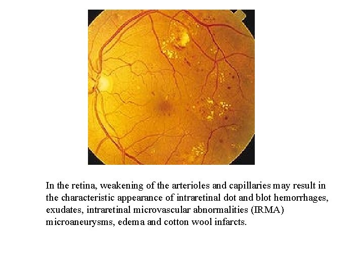 In the retina, weakening of the arterioles and capillaries may result in the characteristic