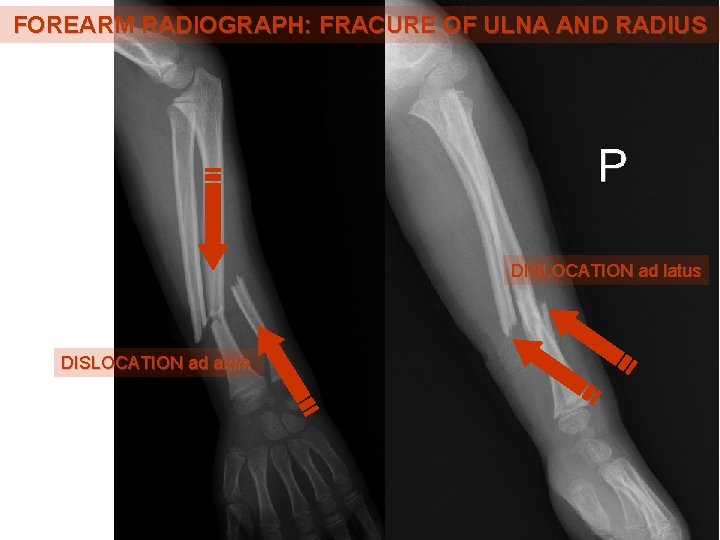 FOREARM RADIOGRAPH: FRACURE OF ULNA AND RADIUS DISLOCATION ad latus DISLOCATION ad axim FOREARM RADIOGRAPH: FRACURE OF ULNA AND RADIUS DISLOCATION ad latus DISLOCATION ad axim