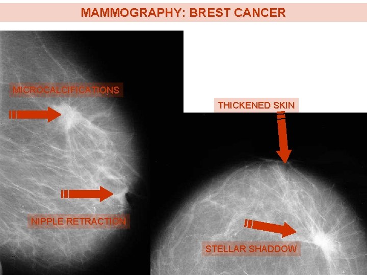 MAMMOGRAPHY: BREST CANCER MICROCALCIFICATIONS THICKENED SKIN NIPPLE RETRACTION STELLAR SHADDOW MAMMOGRAPHY: BREST CANCER MICROCALCIFICATIONS THICKENED SKIN NIPPLE RETRACTION STELLAR SHADDOW