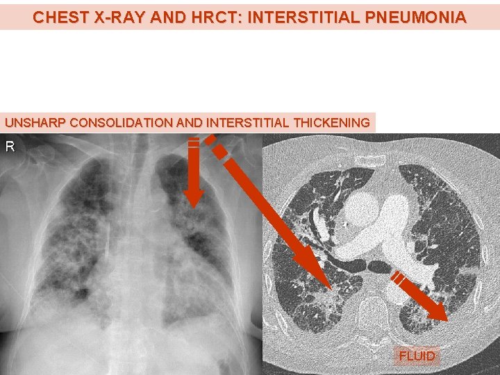 CHEST X-RAY AND HRCT: INTERSTITIAL PNEUMONIA UNSHARP CONSOLIDATION AND INTERSTITIAL THICKENING FLUID CHEST X-RAY AND HRCT: INTERSTITIAL PNEUMONIA UNSHARP CONSOLIDATION AND INTERSTITIAL THICKENING FLUID
