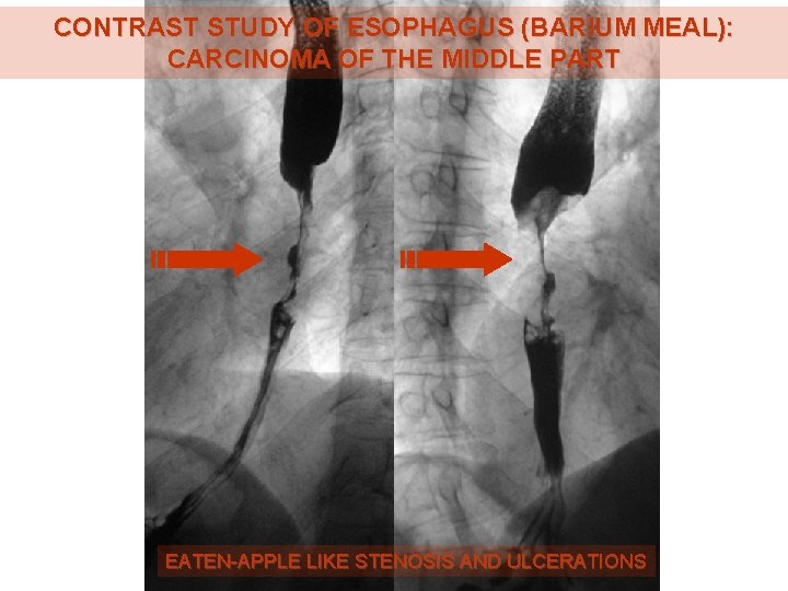 CONTRAST STUDY OF ESOPHAGUS (BARIUM MEAL): CARCINOMA OF THE MIDDLE PART EATEN-APPLE LIKE STENOSIS CONTRAST STUDY OF ESOPHAGUS (BARIUM MEAL): CARCINOMA OF THE MIDDLE PART EATEN-APPLE LIKE STENOSIS
