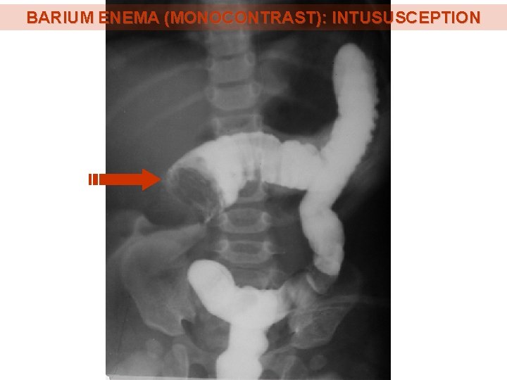 BARIUM ENEMA (MONOCONTRAST): INTUSUSCEPTION BARIUM ENEMA (MONOCONTRAST): INTUSUSCEPTION