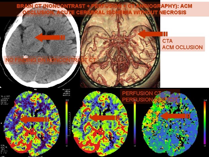 BRAIN CT (NONCONTRAST + PERFUSION + CT ANGIOGRAPHY): ACM OCCLUSION, ACUTE CEREBRAL ISCHEMIA WITHOUT