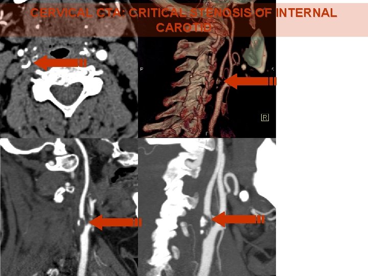 CERVICAL CTA: CRITICAL STENOSIS OF INTERNAL CAROTID 